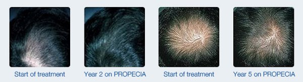 Finasteride 5mg tablets   summary of product 